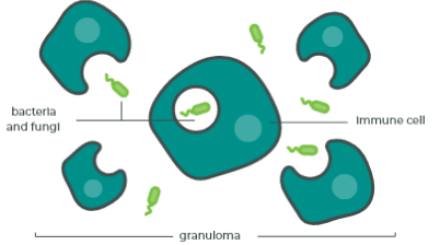 granuloma
